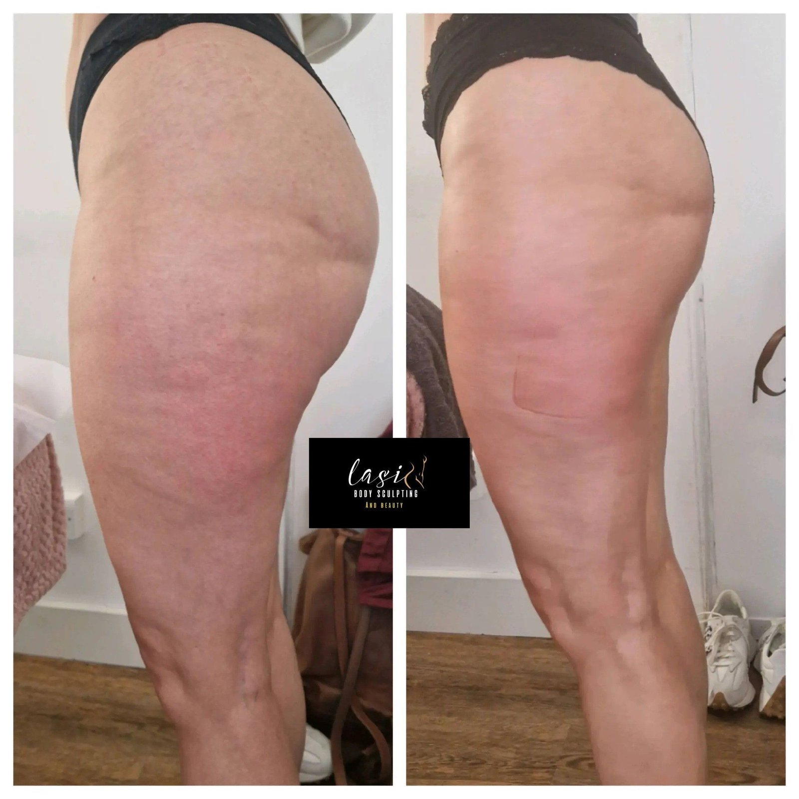 pre cellulite reduction treatment and post cellulite reduction treatment image